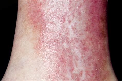 ilustrare eczema varicoasă
